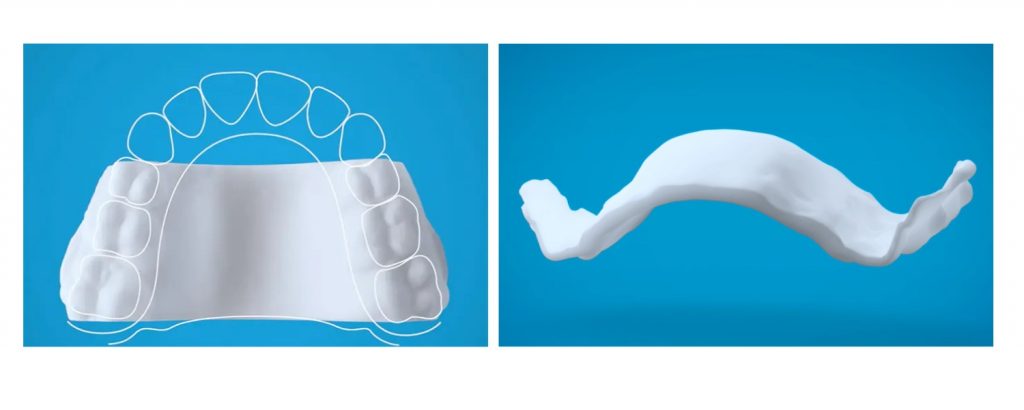Invisalign palatal expanders 3