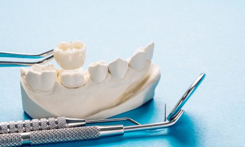 Closeup,/,Prosthodontics,Or,Prosthetic,/,Single,Teeth,Crown,And